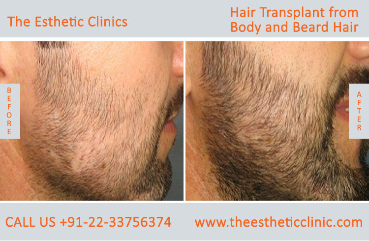 Hair Transplant from Body and Beard Hair before after photos mumbai (1)